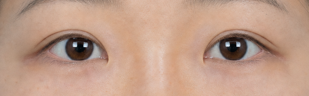 After Eyelid Correction Procedure — Case 1
