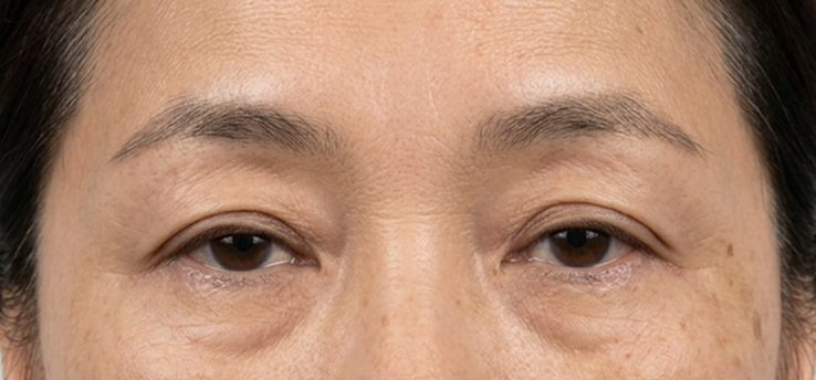Before Eyebrow Lift Surgery — Case 1
