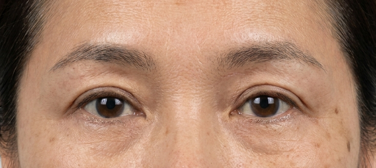 Post-eyebrow lifting procedure — Case 1