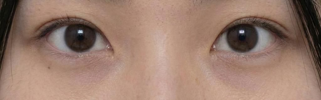 After Lateral and Lower Eyelid Surgery — Case 1