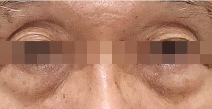 Before Double Eyelid Surgery - Case 1