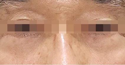 After upper eyelid surgery — Case 1