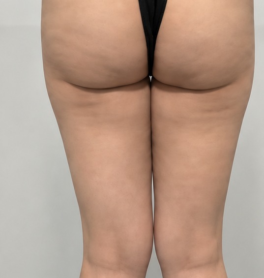 Before the 5-session Cellulite Clinic program - back of thighs and lower buttock line