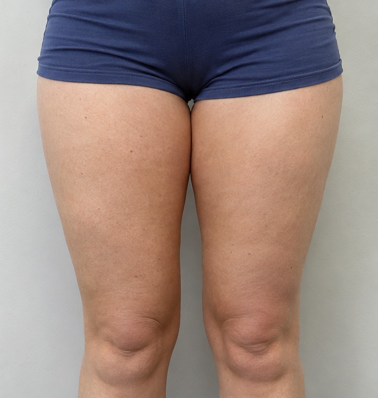 After Cellulite Clinic treatment - Case 2