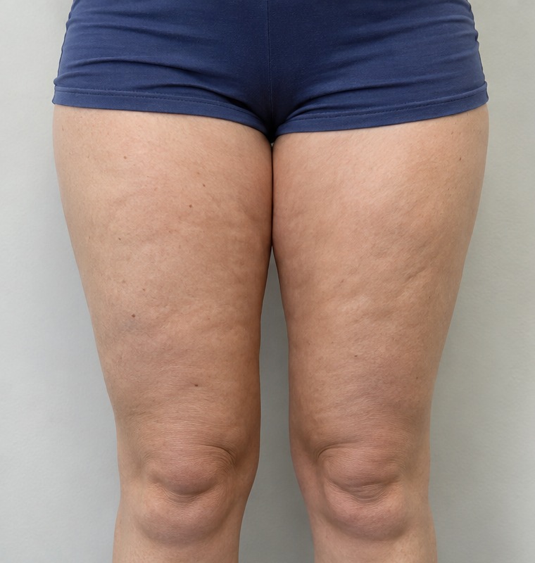 Before Cellulite Clinic treatment - Case 2